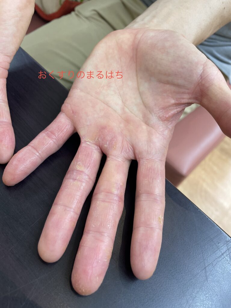汗疱の写真
